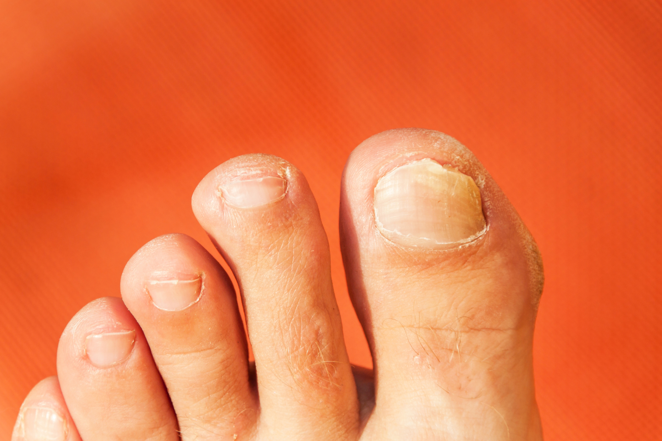 Fungal Infection Protection — Pasco-Hernando Foot & Ankle